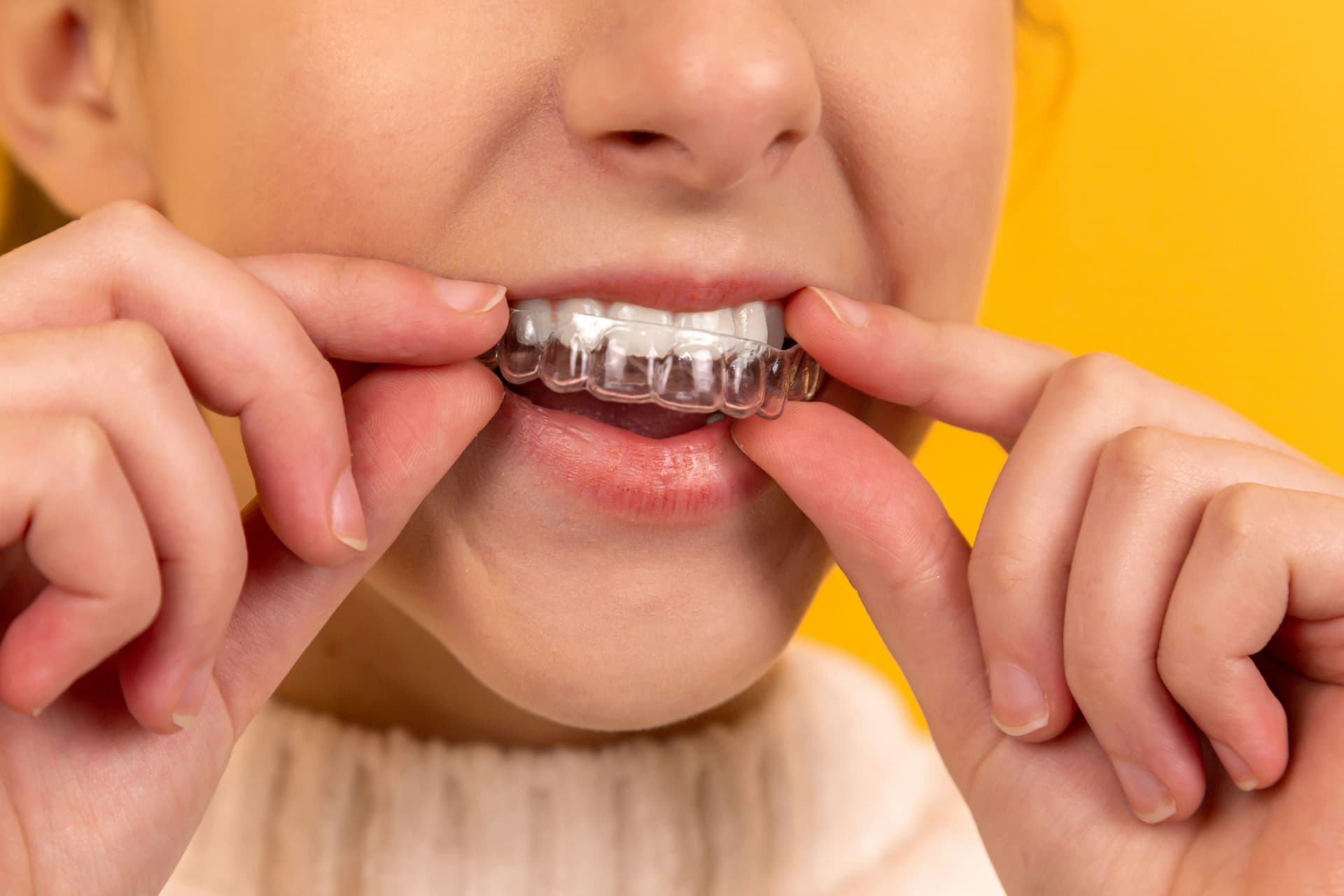 Invisalign vs Braces - Which Treatment Is Right for You?